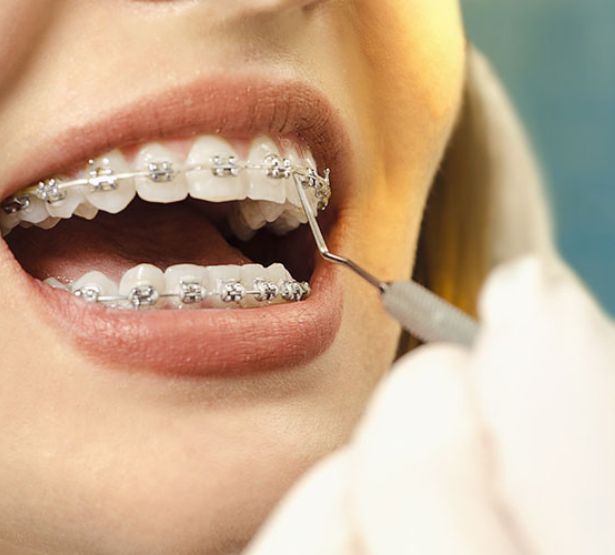 orthodontie dent sagesse macsf